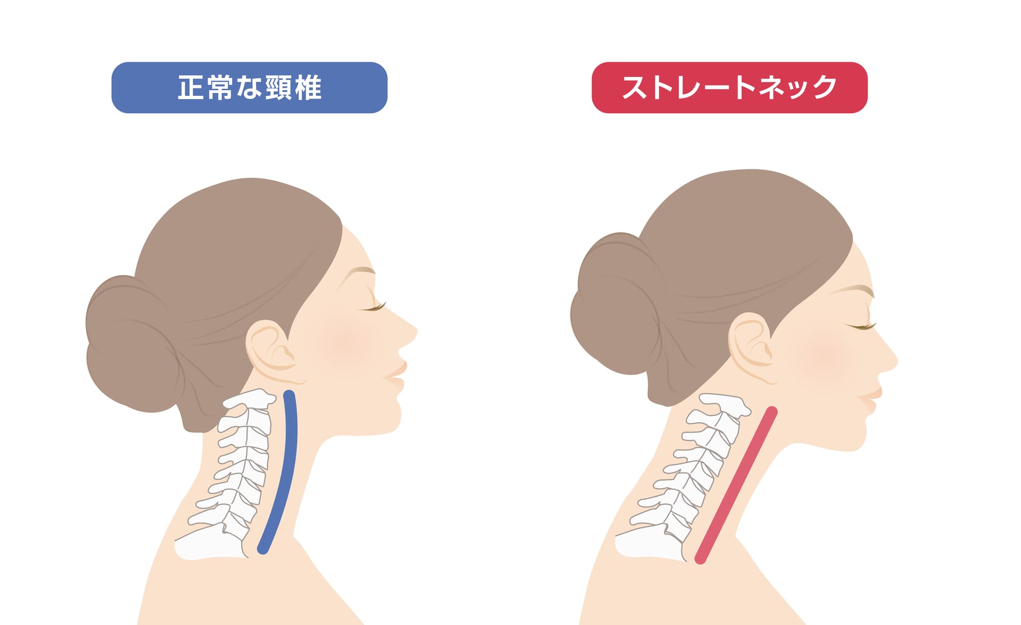 スマホ首（ストレートネック）とは