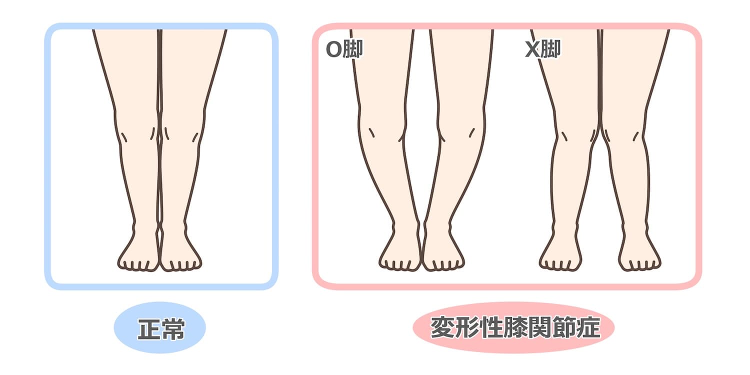 O脚とは